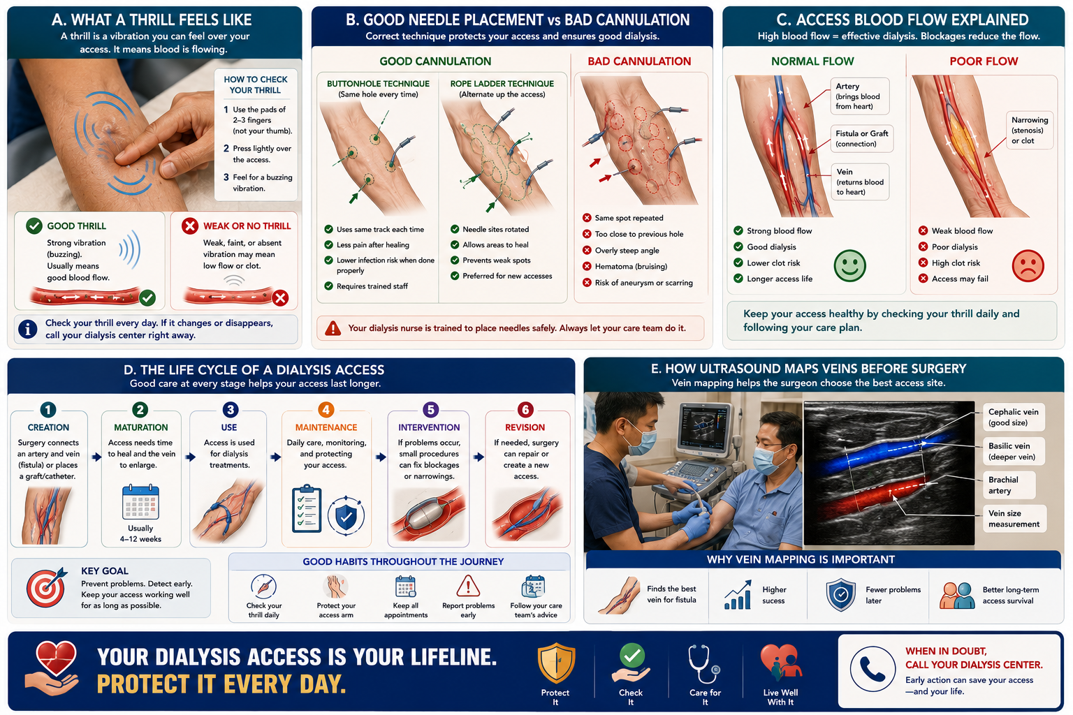 How a thrill feels, good vs bad cannulation, access blood flow, lifecycle of dialysis access, and vein mapping