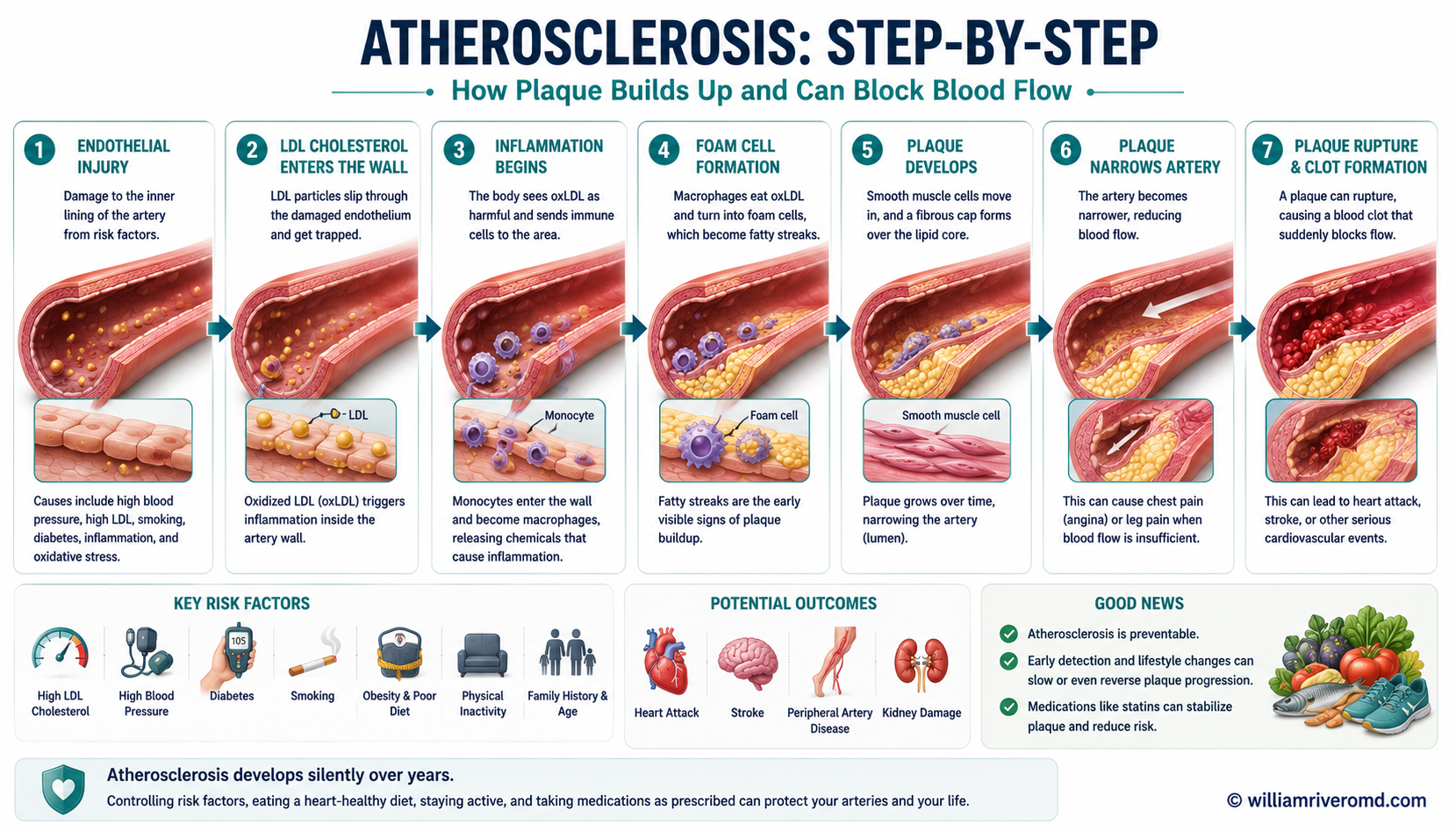 How atherosclerosis develops step by step: endothelial injury, LDL entry and oxidation, foam cell formation, fatty streak to fibrous plaque, and plaque rupture causing heart attack or stroke.