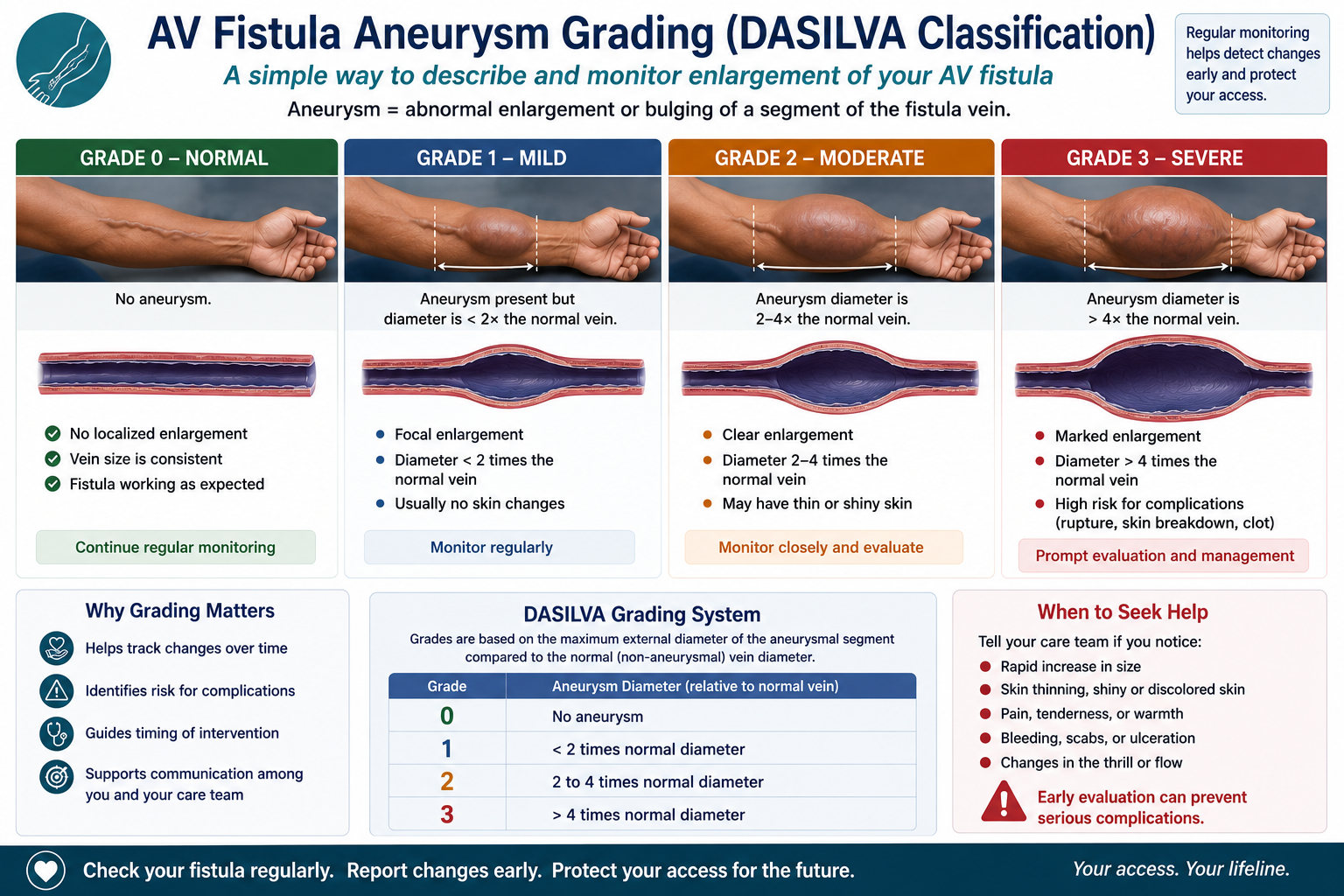 Da Silva Type I through IV aneurysm grading — clinical reference card — by W Rivero, MD