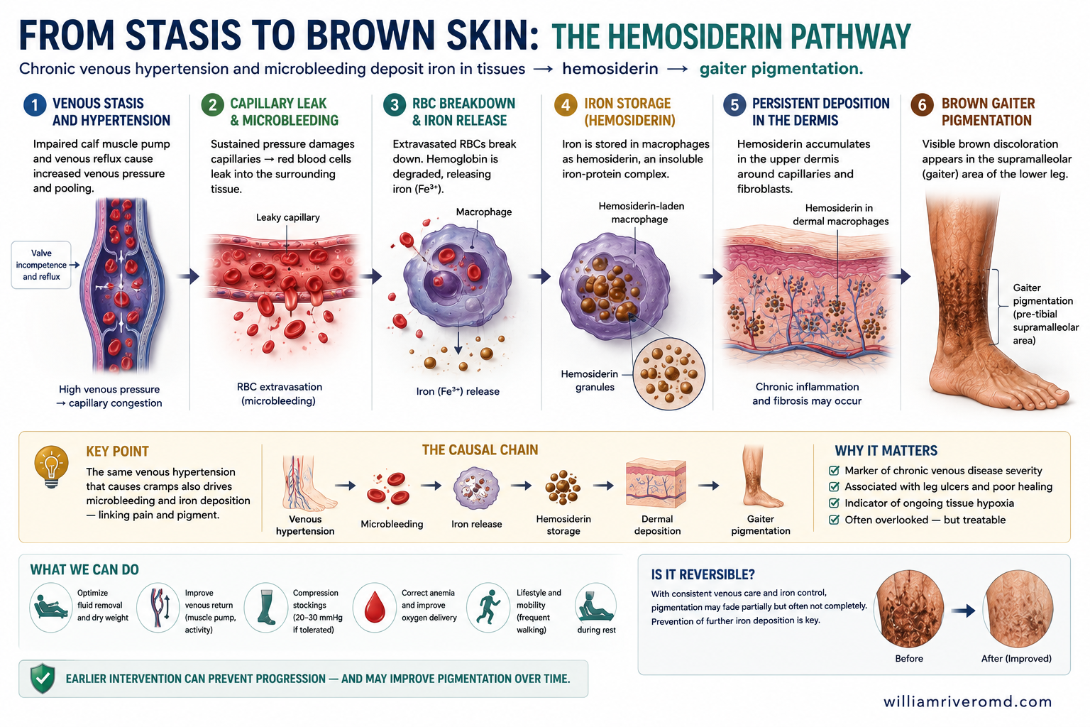Schematic of chronic venous hypertension widening dermal capillary junctions, with red cell extravasation, hemosiderin deposition, matrix metalloproteinase (MMP)-driven matrix damage, and the consequence ladder to stasis ulcer.