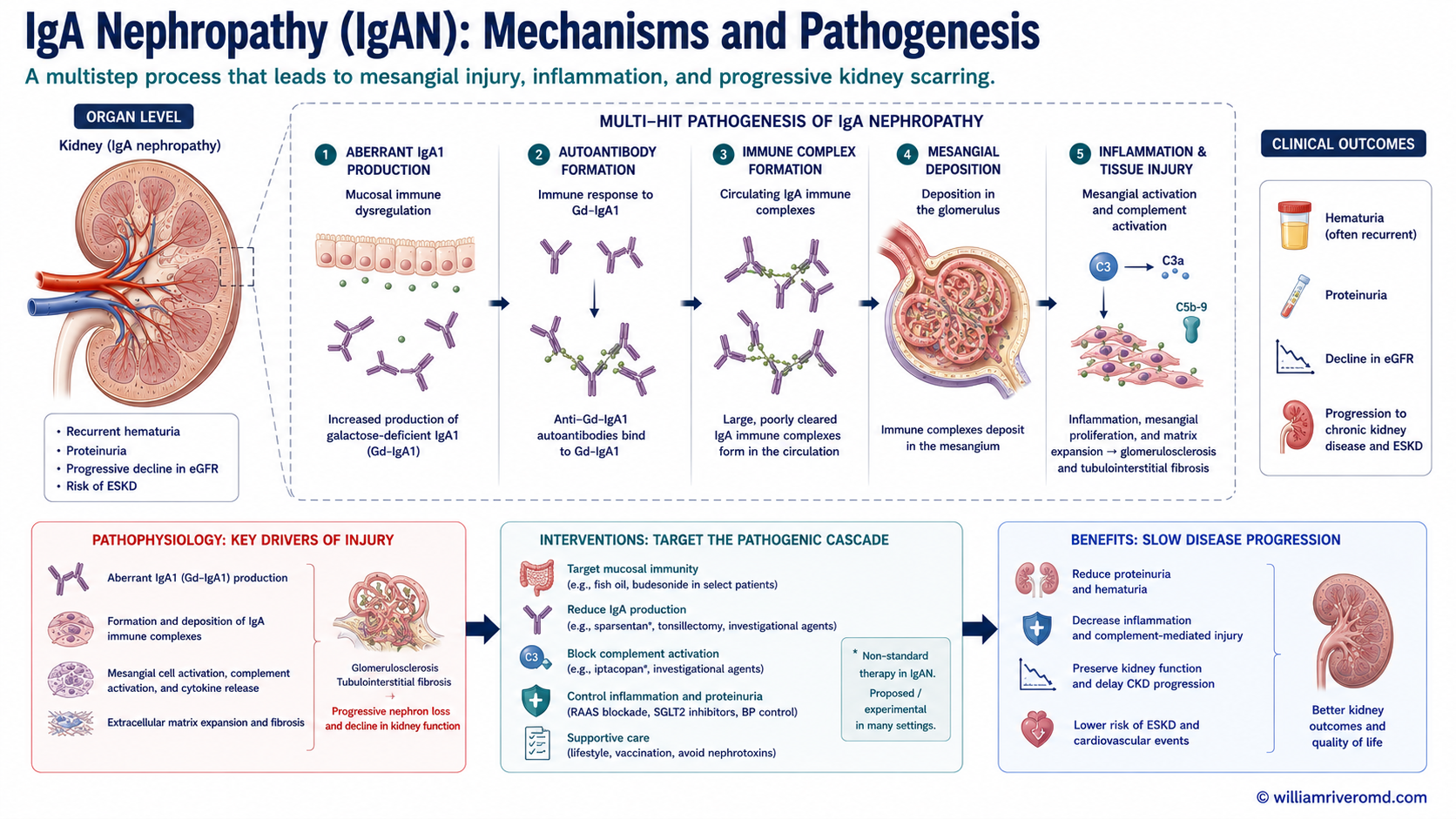Biomedical mechanism schematic of IgA nephropathy: galactose-deficient IgA1 immune complexes deposit in the glomerular mesangium and activate complement, causing mesangial proliferation, hematuria and proteinuria, treated with RAAS blockade, SGLT2 inhibitors, targeted-release budesonide and complement inhibitors