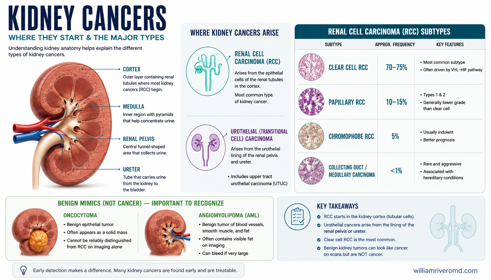 Kidney cross-section anatomy showing where cancers arise — renal cell carcinoma from the cortex and urothelial cancer from the renal pelvis and ureter — with the major RCC subtypes and their frequencies