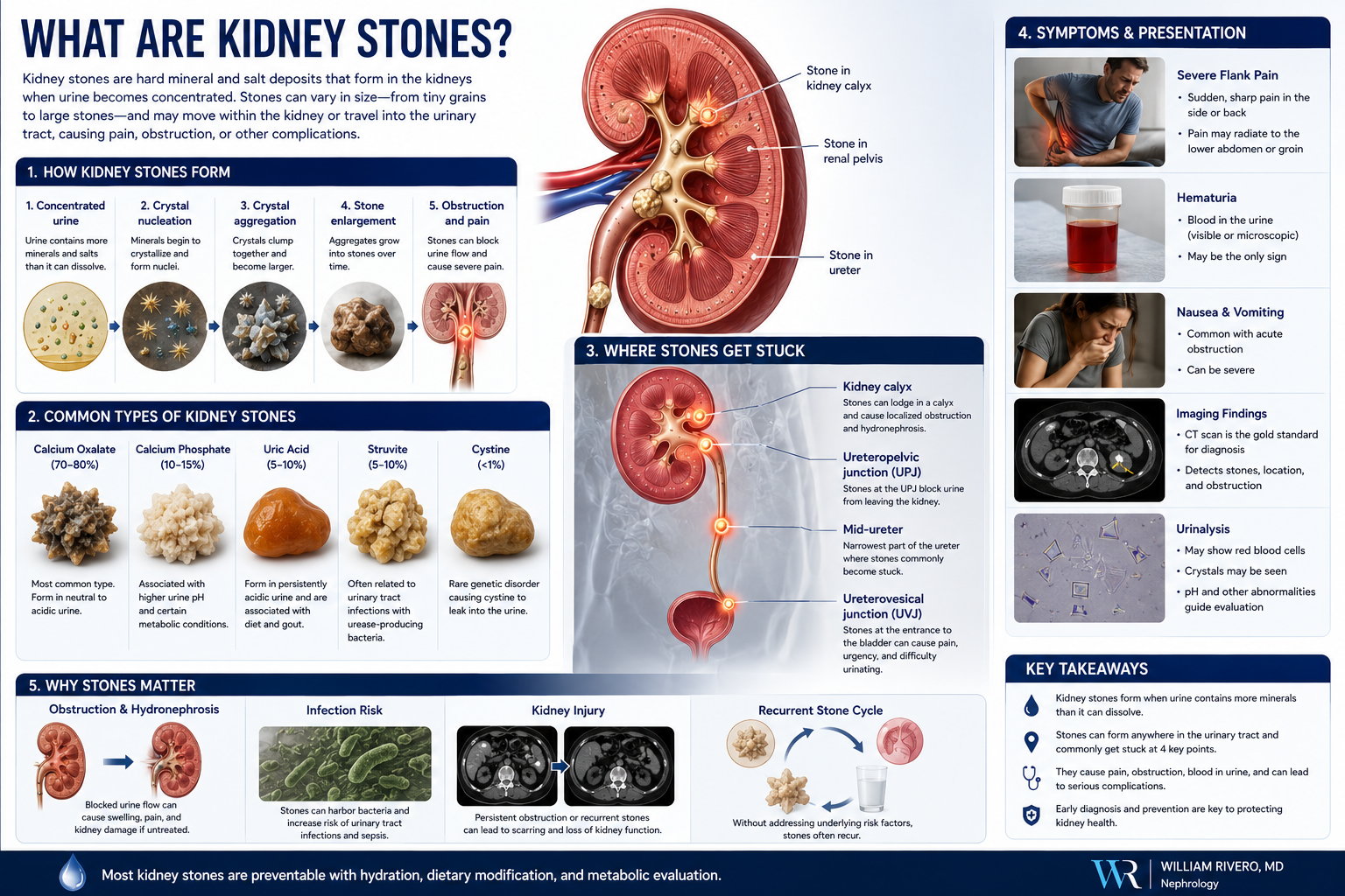 Kidney Stones comprehensive guide — types, causes, symptoms, treatment, and prevention strategies