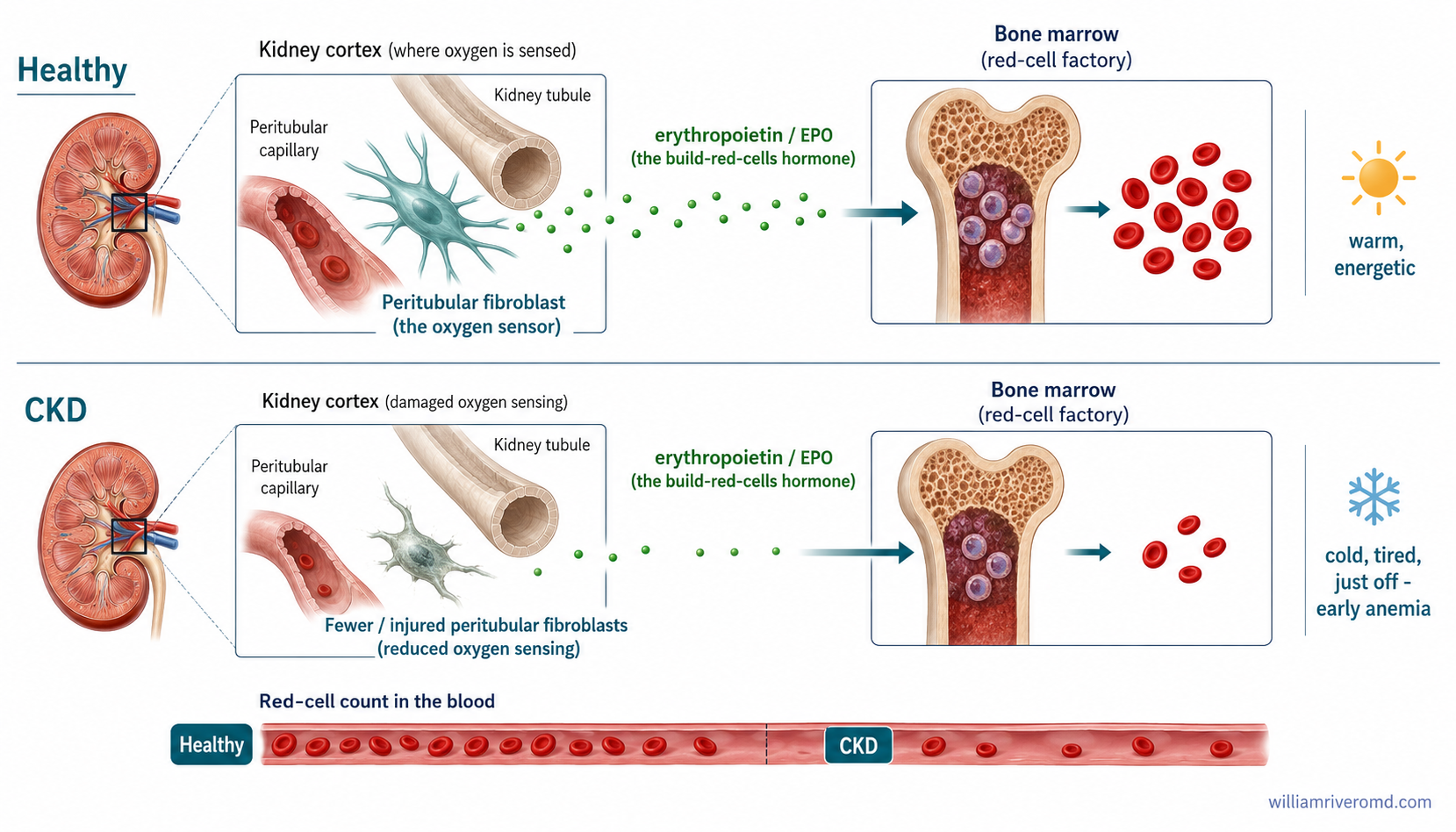 A two-row comparison showing a healthy kidney's peritubular fibroblasts releasing erythropoietin to the bone marrow for normal red blood cell production, versus fewer, injured fibroblasts in CKD producing less EPO and lower red cell counts