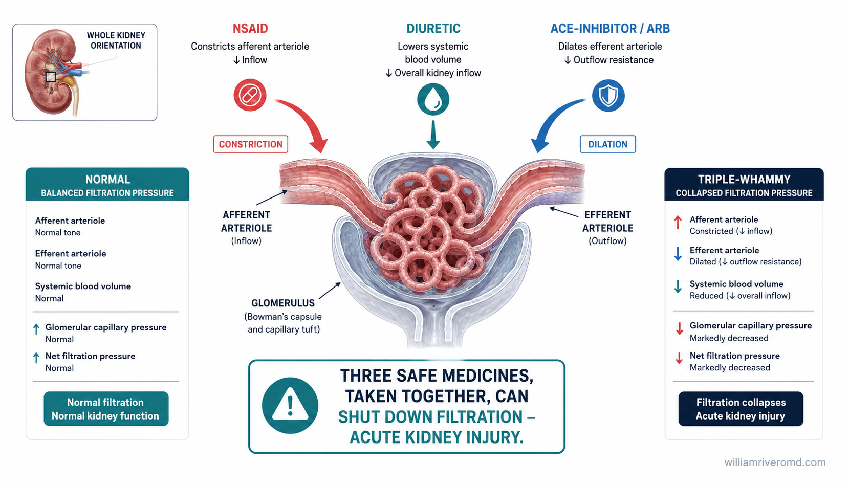 A glomerulus with an afferent arteriole narrowed by an NSAID and an efferent arteriole widened by an ACE-inhibitor or ARB, plus a diuretic lowering circulating volume, together collapsing filtration pressure